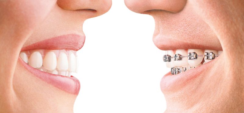 Zahnspange Invisalign links - konventionelle festsitzende Zahnspange rechts