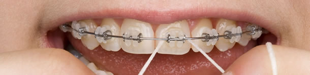 Zahnspange festsitzend Brackets, Dentalhygiene